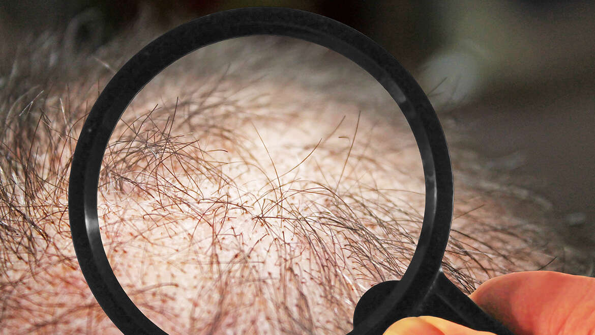 Krankheiten – Haarausfall